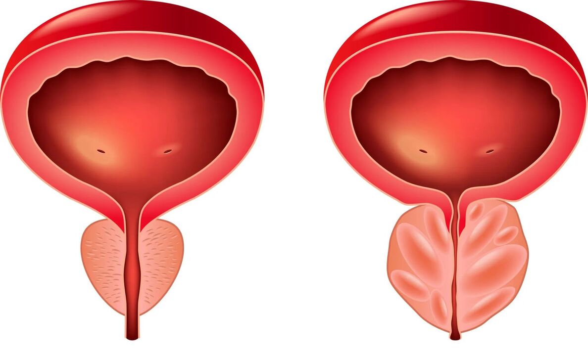 normale und erkrankte Prostata