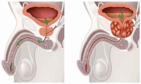 gesunde und entzündete Prostata mit Prostatitis