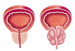 Prostatitis