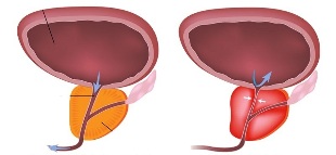 Prostatitis bei Männern