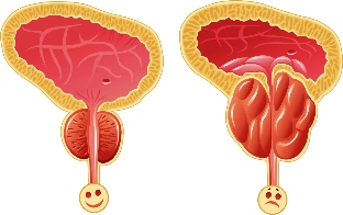 Normale Prostata und entzündete