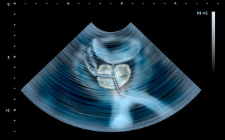 Anzeichen von Prostatitis im Ultraschall