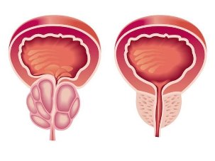 Wie sieht Prostatitis